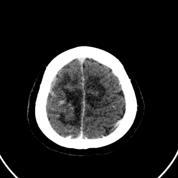 Cerebral venous hemorrhagic infarct from venous sinus thrombosis (Radiopaedia 55433-61883 Axial C+ delayed 25).jpg
