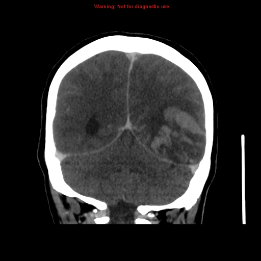 Cerebral venous infarction (Radiopaedia 12404-20735 B 60).jpg