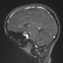 Cerebral venous infarction - hemorrhagic (Radiopaedia 81625-95505 Sagittal MRV 43).jpg