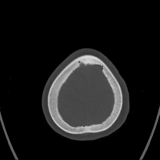 Cerebral venous infarction with hemorrhage (Radiopaedia 65343-74381 Axial bone window 175).jpg