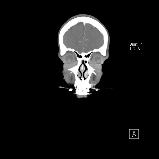 Cerebral venous infarction with hemorrhage (Radiopaedia 65343-74396 B 28).jpg