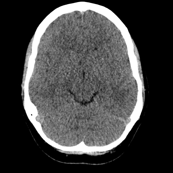 Cerebral venous sinus thrombosis (Radiopaedia 59224-66551 Axial non-contrast 1).jpg