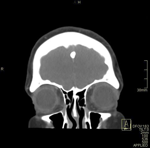 Cerebral venous sinus thrombosis (Radiopaedia 91329-108965 Coronal venogram 13).jpg