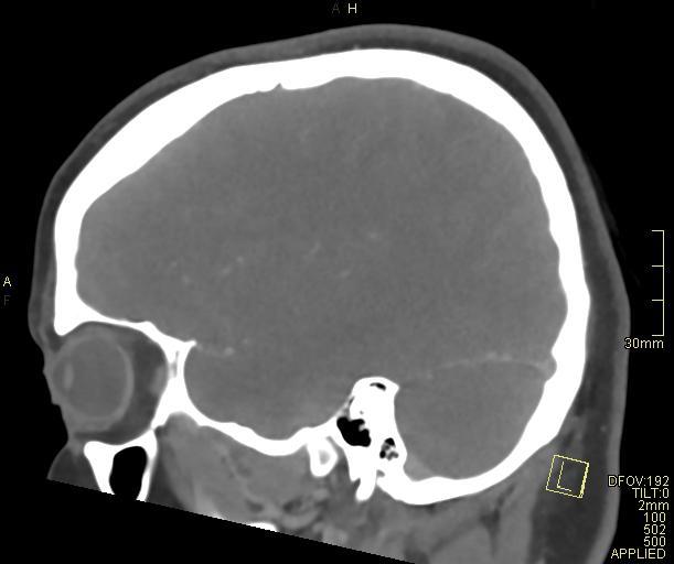 Cerebral venous sinus thrombosis (Radiopaedia 91329-108965 Sagittal venogram 21).jpg