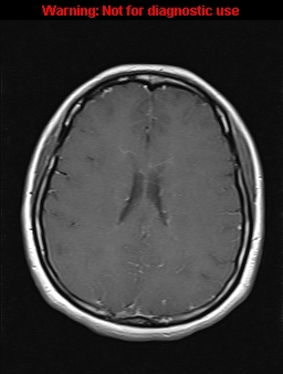 File:Cerebral venous thrombosis (Radiopaedia 37224-39208 Axial T1 C+ 14).jpg