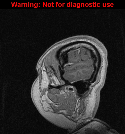 File:Cerebral venous thrombosis (Radiopaedia 37224-39208 Sagittal T1 C+ 16).jpg
