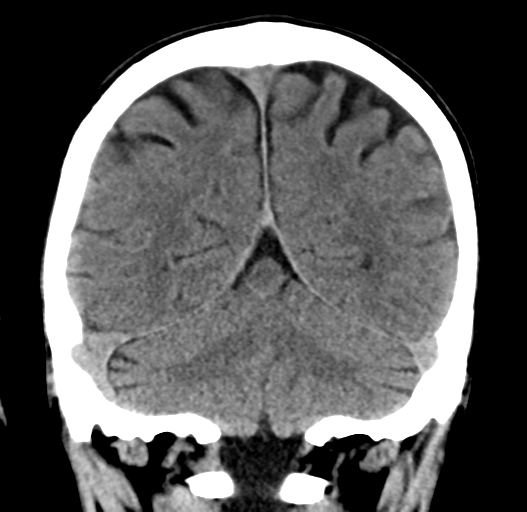 File:Cerebral venous thrombosis (Radiopaedia 38392-40467 Coronal non-contrast 28).png