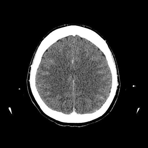 Cerebral venous thrombosis with venous hemorrhagic infarct (Radiopaedia 90354-107660 Axial with contrast 114).jpg