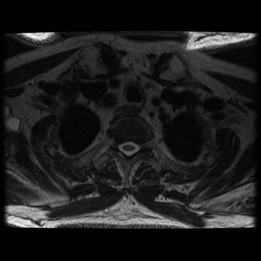 File:Cervical canal stenosis with cord compression (Radiopaedia 34114-35374 Axial T2 6).png