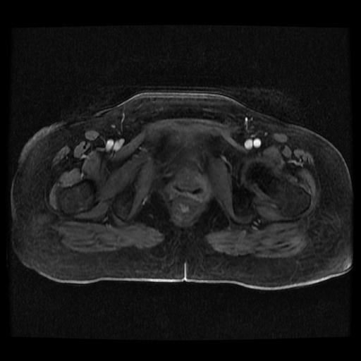 File:Cervical carcinoma (Radiopaedia 70924-81132 Axial T1 C+ fat sat 31).jpg