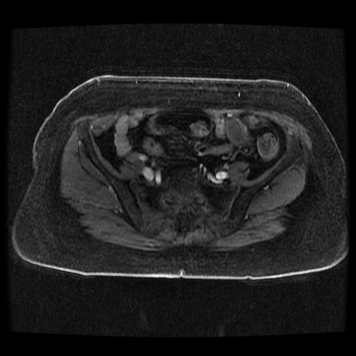 Cervical carcinoma (Radiopaedia 70924-81132 Axial T1 C+ fat sat 71).jpg