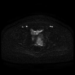 Cervical carcinoma (Radiopaedia 85405-101028 Axial DWI 48).jpg