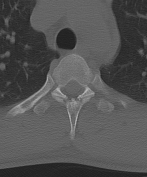 Cervical intercalary bone (Radiopaedia 35211-36748 Axial bone window 77).png
