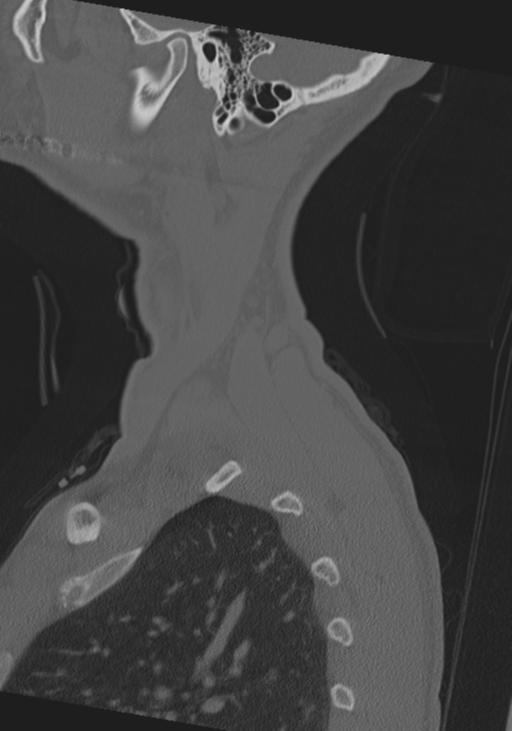Cervical intercalary bone (Radiopaedia 35211-36748 Sagittal bone window 77).png
