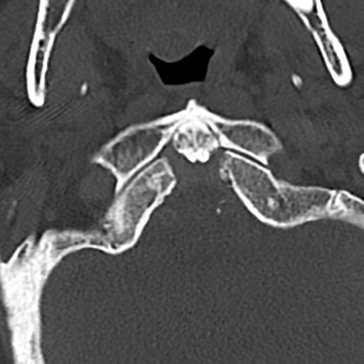 Cervical spine fracture - chalk stick (Radiopaedia 39116-41323 Axial bone window 12).png
