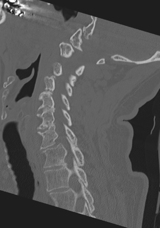 Cervical spine fractures with vertebral artery dissection (Radiopaedia 53296-59268 Sagittal bone window 27).png