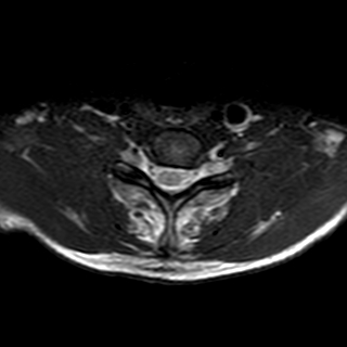 File:Cervical spine posterior ligamentous complex rupture (Radiopaedia 63486-72103 Axial T2 5).jpg