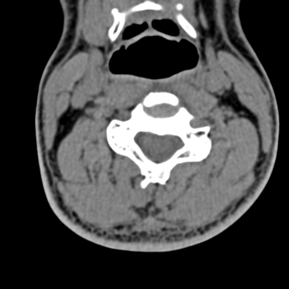 Cervical spondylodiscitis (Radiopaedia 28057-29489 Axial non-contrast 38).jpg