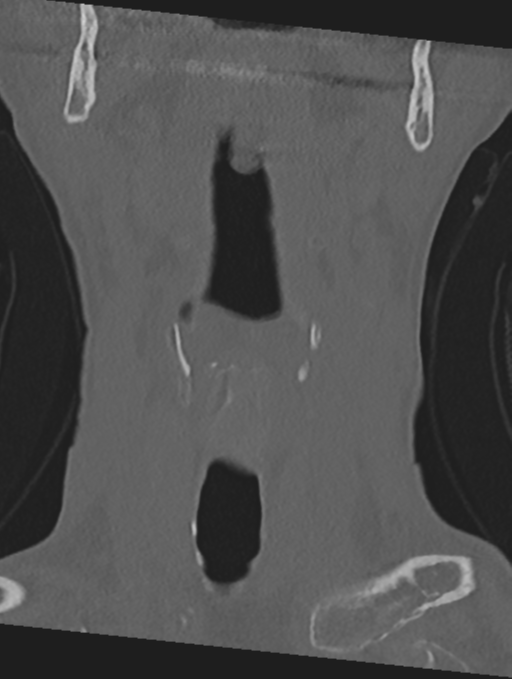 Cervical spondylolysis (Radiopaedia 49616-54811 Coronal bone window 3).png