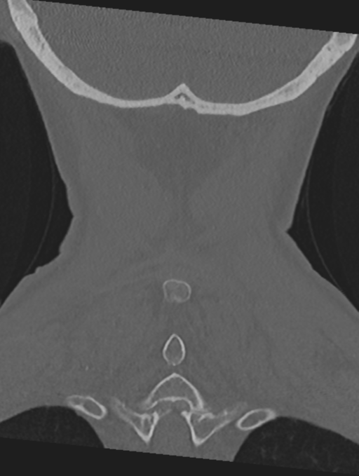 Cervical spondylolysis (Radiopaedia 49616-54811 Coronal bone window 52).png