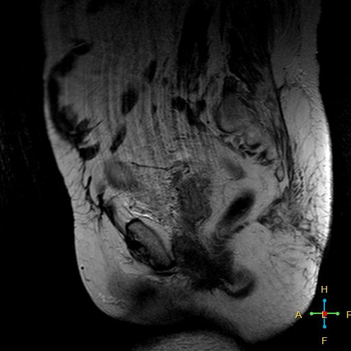 File:Cervical stump squamous cell carcinoma (Radiopaedia 48049-52858 Sagittal T2 5).jpg