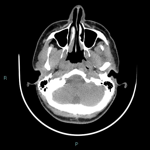 File:Cervical thymic cyst (Radiopaedia 88632-105335 Axial non-contrast 104).jpg