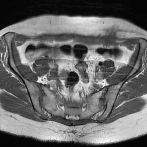 File:Cesarian section scar endometriosis (Radiopaedia 66520-75799 Axial T1 4).jpg