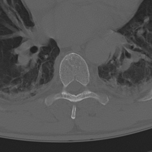 Chance fracture (Radiopaedia 33854-35020 Axial bone window 47).png