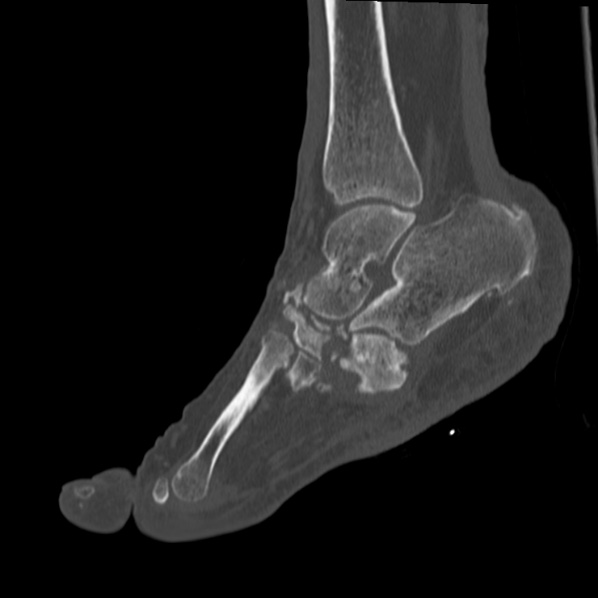 Charcot joint (Radiopaedia 36629-38194 Sagittal bone window 47).jpg