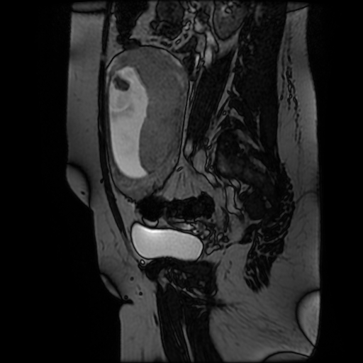 Chiari II malformation - fetal MRI (Radiopaedia 68099-77581 Sagittal Fiesta 39).jpg