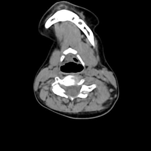 Chiari I with syrinx and skull base anomalies (Radiopaedia 89444-106412 Axial non-contrast 88).jpg