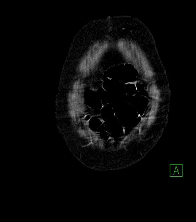 Cholangiocarcinoma with cerebral metastases (Radiopaedia 83519-98629 E 5).jpg