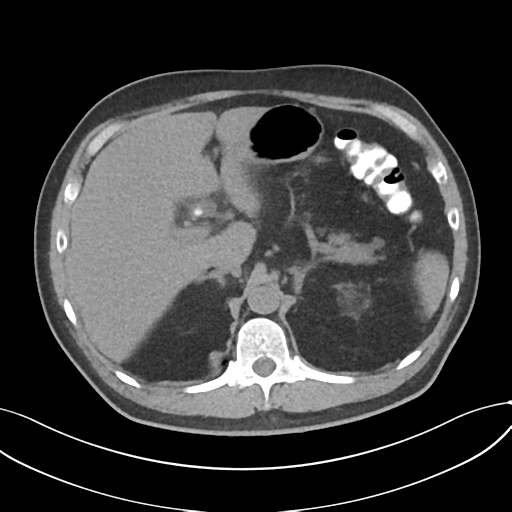 File:Cholecystitis with focal perforation and hepatic abscess (Radiopaedia 37189-38945 Axial non-contrast 22).png