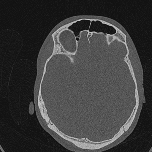 Cholesteatoma (Radiopaedia 70429-80529 Axial bone window 128).jpg