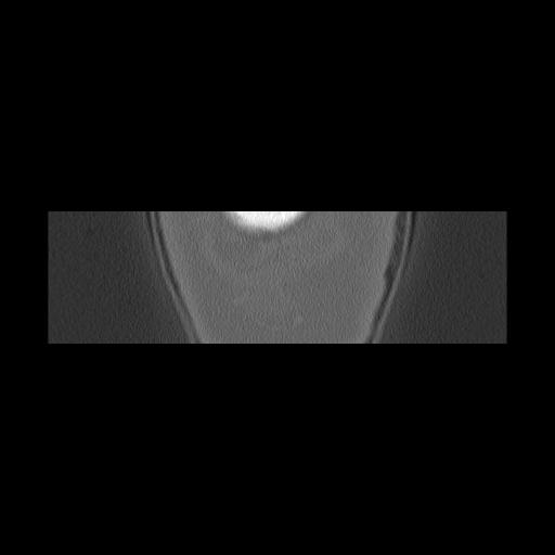 File:Cholesteatoma (Radiopaedia 84946-100455 Coronal bone window 173).jpg