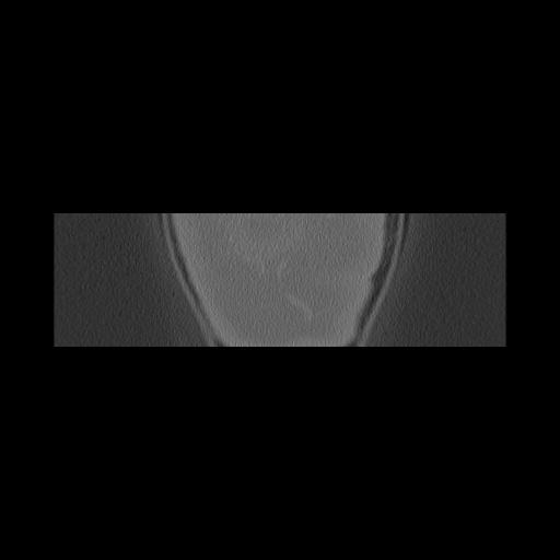 Cholesteatoma (Radiopaedia 84946-100455 Coronal bone window 176).jpg