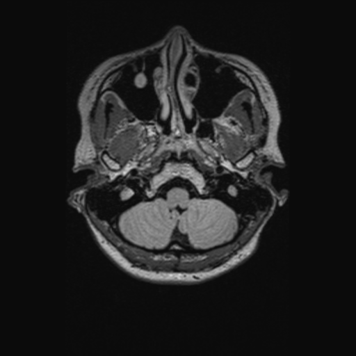 Chondrosarcoma (Radiopaedia 41937-44939 Axial FLAIR 19).png