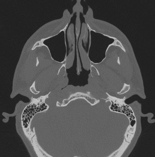 Chondrosarcoma (clivus) (Radiopaedia 46895-51425 Axial bone window 62).png
