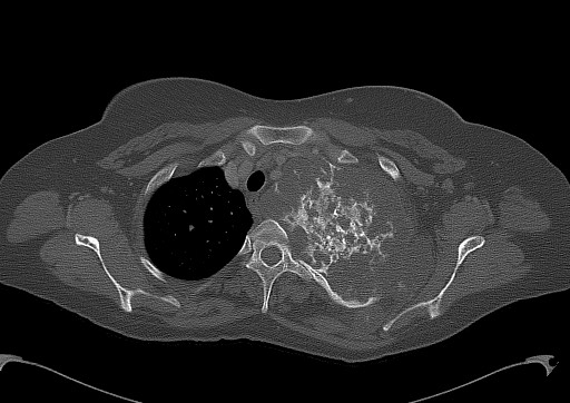 Chondrosarcoma - chest wall (Radiopaedia 65192-74199 Axial bone window 27).jpg