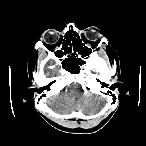 File:Choriocarcinoma of ovary with cerebral and pulmonary metastases (Radiopaedia 25983-26118 C+ arterial phase 20).jpg