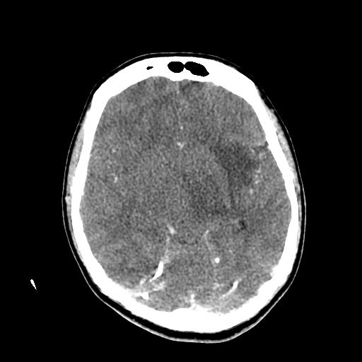 File:Choriocarcinoma of ovary with cerebral and pulmonary metastases (Radiopaedia 25983-26118 C+ arterial phase 74).jpg