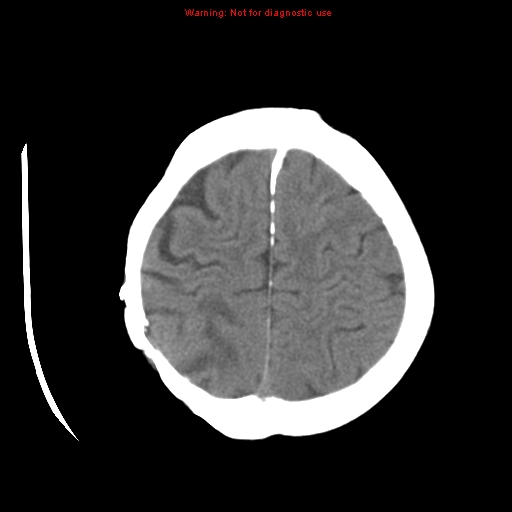 File:Choroid plexus carcinoma - recurrent (Radiopaedia 8330-9168 Axial non-contrast 23).jpg