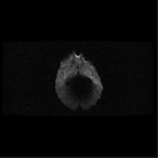 Choroid plexus papilloma (Radiopaedia 34951-36441 Axial DWI 13).png