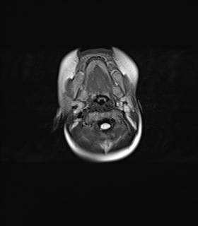File:Choroid plexus papilloma (Radiopaedia 84612-100019 Axial FLAIR 1).jpg