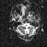 Choroid plexus xanthogranuloma - unilateral (Radiopaedia 85632-101393 Axial ADC 5).jpg