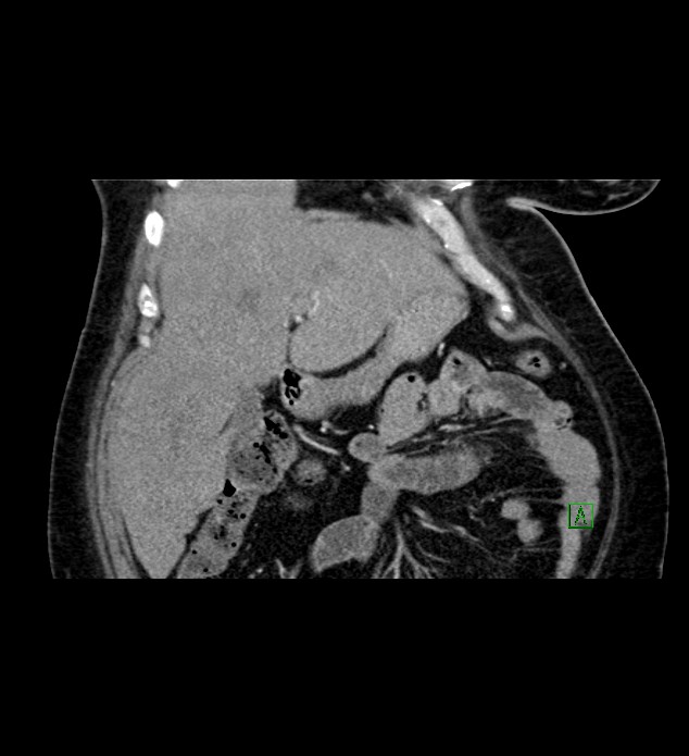 Chromophobe renal cell carcinoma (Radiopaedia 84239-99519 C 28).jpg