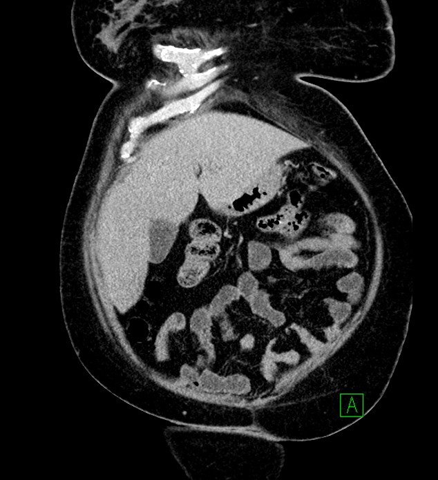 Chromophobe renal cell carcinoma (Radiopaedia 84239-99519 F 21).jpg