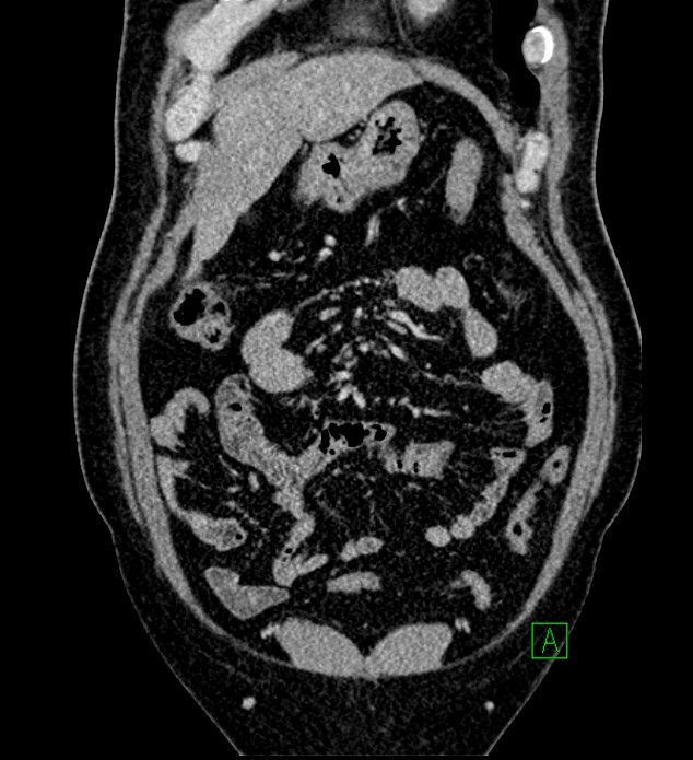 Chromophobe renal cell carcinoma (Radiopaedia 84286-99573 H 45).jpg