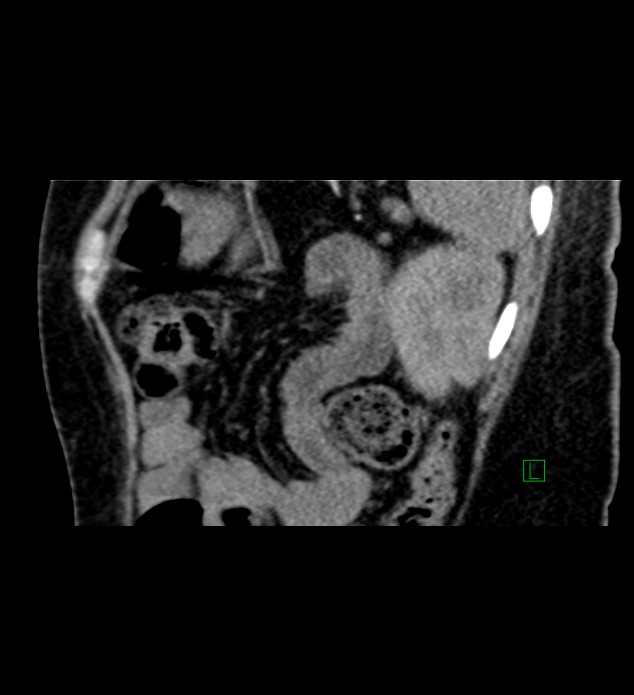 Chromophobe renal cell carcinoma (Radiopaedia 84290-99582 D 21).jpg