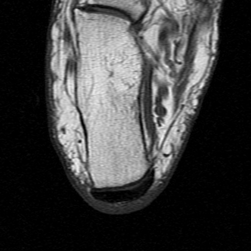 File:Chronic Achilles tendon rupture (Radiopaedia 15262-15100 Axial T1 24).jpg